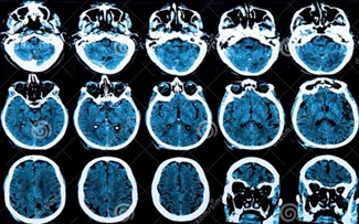 MRI常用術(shù)語（上）