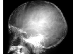 醫(yī)學(xué)影像學(xué)骨骼系統(tǒng)復(fù)習(xí)重點(diǎn)