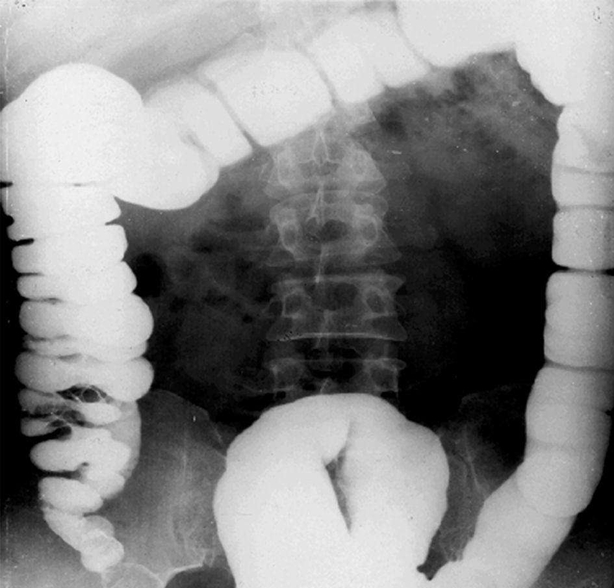 醫(yī)學(xué)影像學(xué)消化系統(tǒng)復(fù)習(xí)重點(diǎn)