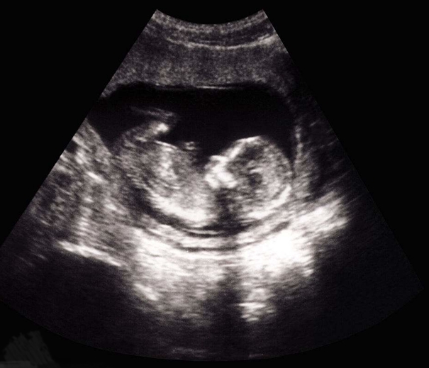 醫(yī)學(xué)影像學(xué)——超聲