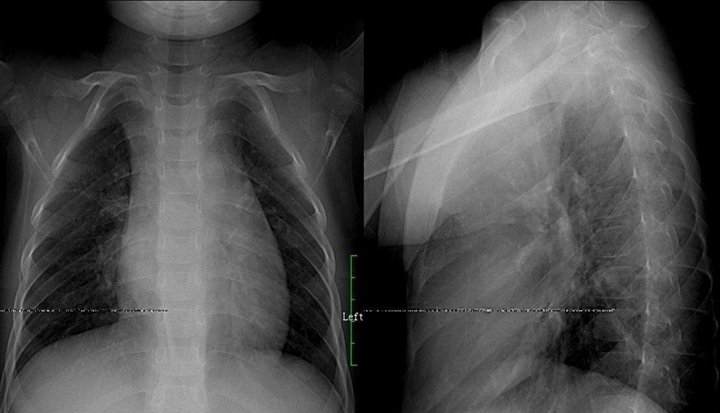 醫(yī)學(xué)影像學(xué)口訣——呼吸系統(tǒng)
