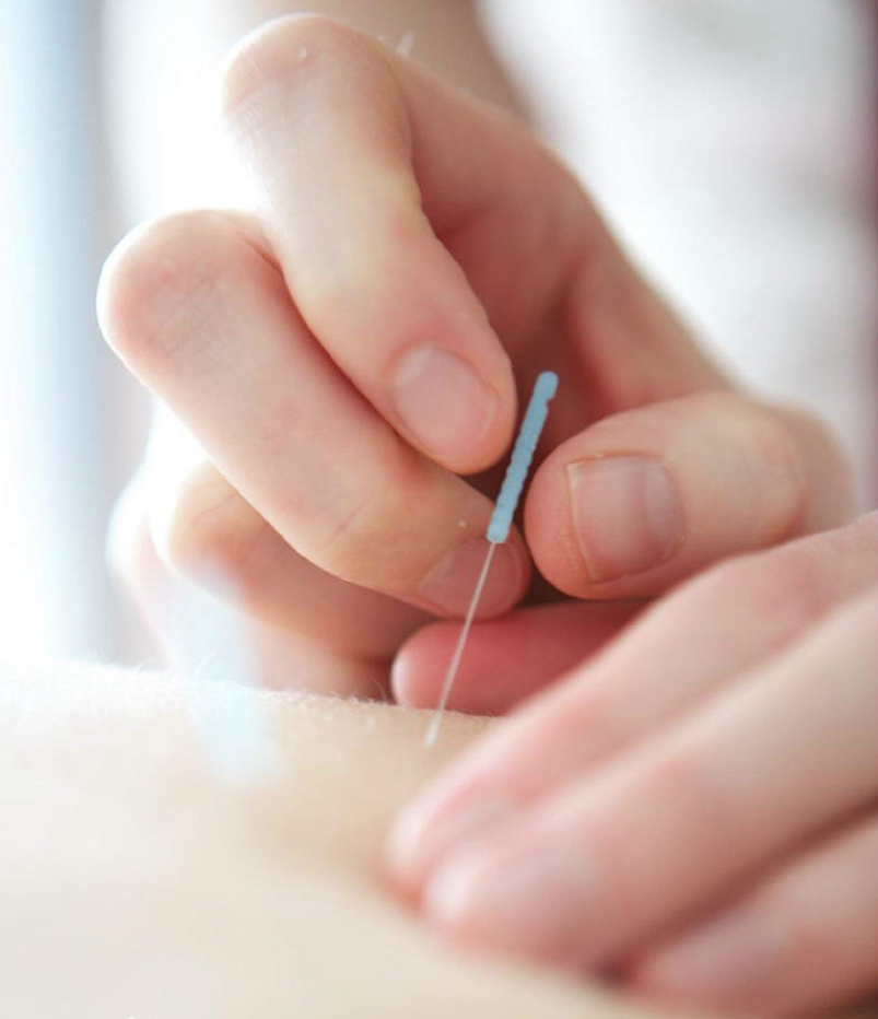 中醫(yī)針灸能治什么病